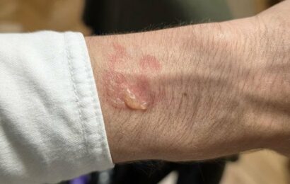Varování pro majitele Samsung Galaxy Watch: Hodinky se mohou kvůli chybě přehřát a způsobit puchýře Varování pro majitele Samsung Galaxy Watch: Hodinky se mohou kvůli chybě přehřát a způsobit puchýře